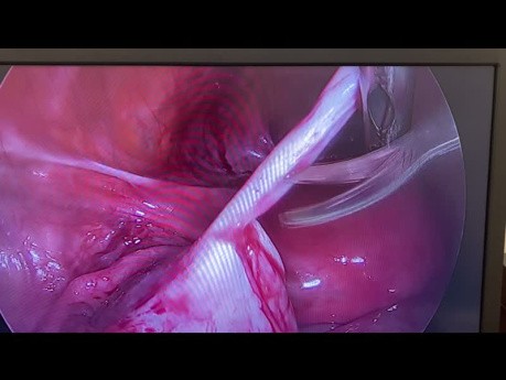 Laparoscopic Left Ovarian Cystectomy and Adehesiolysis