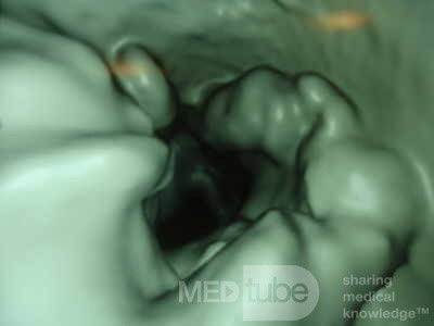 Adenocarcinoma of the Transverse Colon (2 of 15)