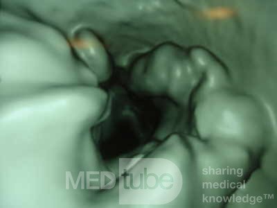 Adenocarcinoma of the Transverse Colon (2 of 15)