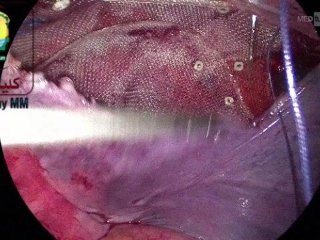 Peritoneal Closure in TAPP Hernia Repair to Cover the Mesh is an Essential Step
