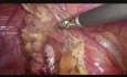 Laparoscopic Appendisectomy