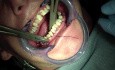Jaw Fracture - Ivy Loop Placement Intraorally
