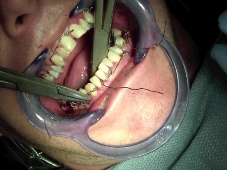 Jaw Fracture - Ivy Loop Placement Intraorally