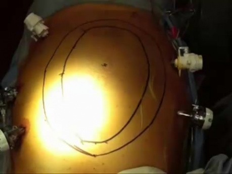 Laparoscopic incisional hernia repair