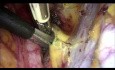 The Laparoscopic Type B Radical Hysterectomy with Isolation of Cervical Tumor