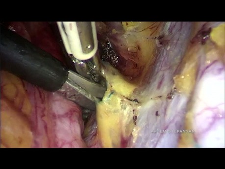 The Laparoscopic Type B Radical Hysterectomy with Isolation of Cervical Tumor