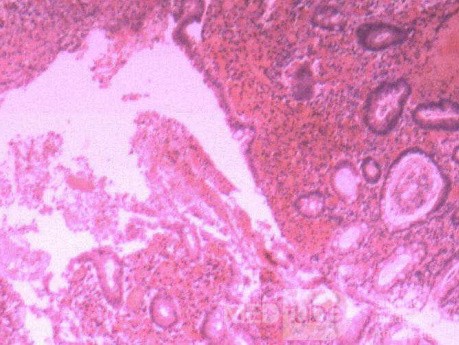 Multiple Rectal Ulcers (104 of 110)
