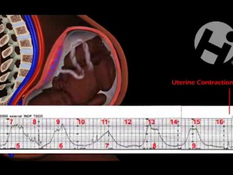 Anatomy and Location of Cesarean Scar