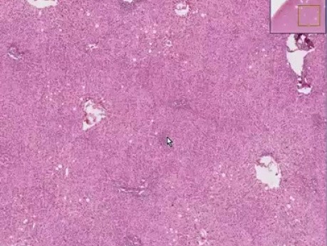 Viral hepatitis