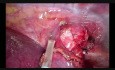 Advanced VATS Instrumentation Lymph Node Dissection