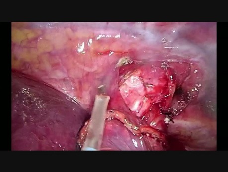 Advanced VATS Instrumentation Lymph Node Dissection