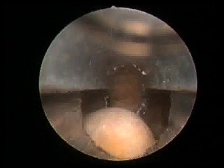 Bladder Stone - Post Greenlight HPS