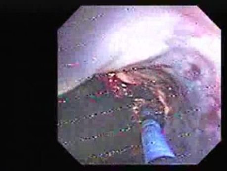 Hemorrhage After Ligation - Acute Variceal Bleeding After Treatment