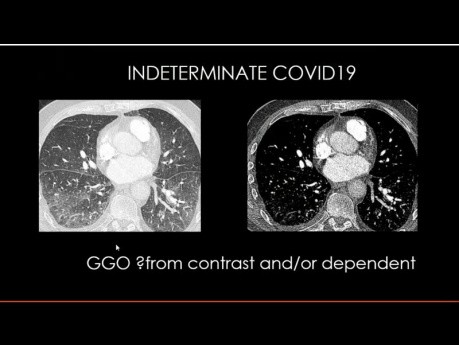 Thoracic Imaging in Corona 