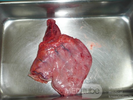 Adenocarcinoma of the cardias and gastric fundus with signet-ring cells (7 of 25)