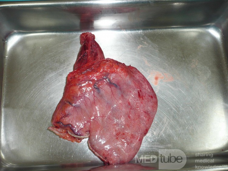 Adenocarcinoma of the cardias and gastric fundus with signet-ring cells (7 of 25)