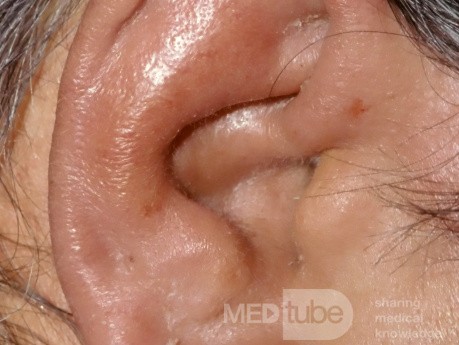 Acute Perichondritis