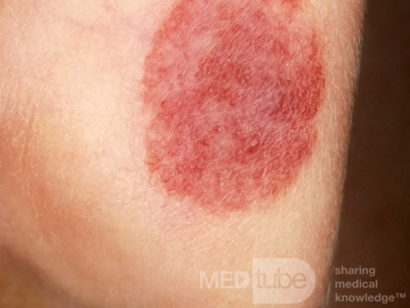 Capillary Hemangioma