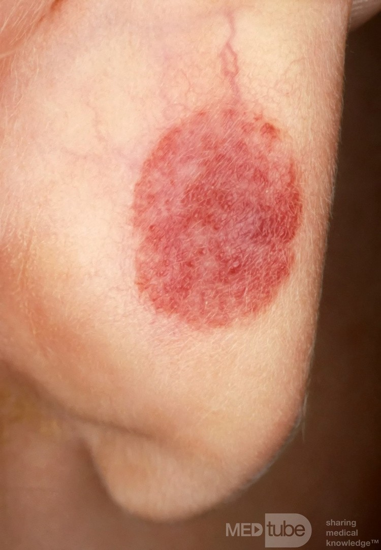 Capillary Hemangioma
