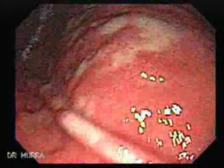 Systemic Lupus Erythematosus - Stomach finding (4 of 7)