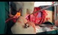 Simultaneous Heart and Liver Tumor Removal 