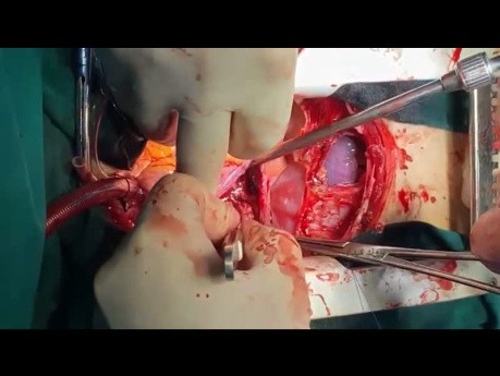 Simultaneous Heart and Liver Tumor Removal 