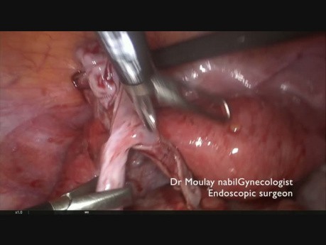 Challenging Conservative Treatment on 18 cm Dermoid Ovarian Cyst