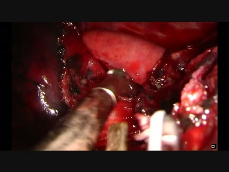 Uniportal Vats Lingular and Left Lower Bronchial Sleeve Lobectomy
