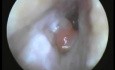 An Immflamatory Polyp Of The Ear Passage - Suction Clearance