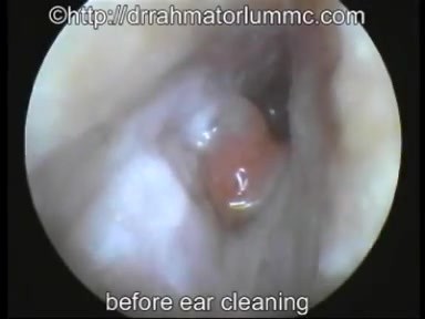 An Immflamatory Polyp Of The Ear Passage - Suction Clearance