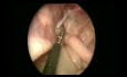 Laparoscopic Pyloromyotomy and Percutaneous Inguinal Ring Suturing in 47 day Old Baby