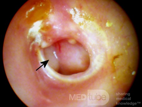 Chronic Suppurative Otitis Media: Active Stage