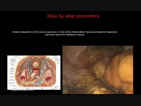 Laparoscopic Abdominoperineal Rectal Resection with Total Mesorectal Excision for a Large Ano-Rectal Tumor (with Drawings)