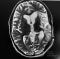 Decompressive Craniotomy