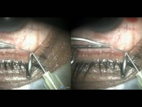 Transciliary Filtration in a Case of Neovascular Glaucoma