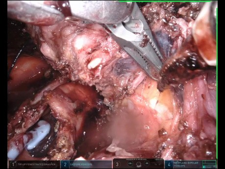 Bronchial Tumor Difficult Location