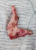 Total Resection of the Lesion Through a Lateral Fronto-Zygomatic Orbit Approach
