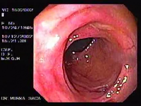 Diverticulitis - Endoscopy