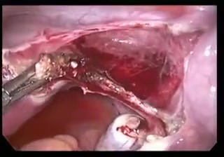Noncommunicating Rudimentary Horn 19-wks Pregnancy Excision Done with Laproscopy