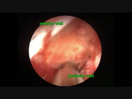 Renal Pelvis Laceration During PCNL