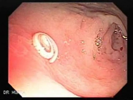 Trichuris Trichuris (whipworm) (4 of 4)