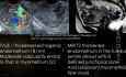 Ultrasound Post Partum Post-Abortion Hemorrhage