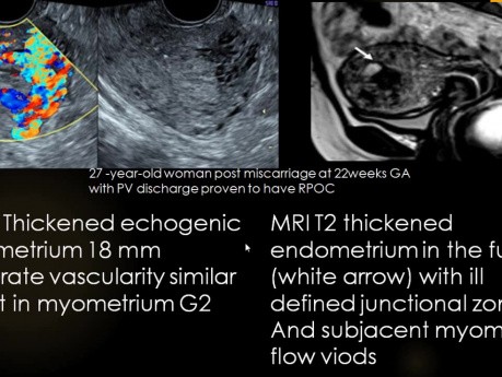 Ultrasound Post Partum Post-Abortion Hemorrhage