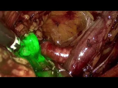 vNOTES SLNB for Endometrial Cancer