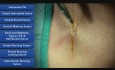 Simple Buried Suture - Suture Techniques 