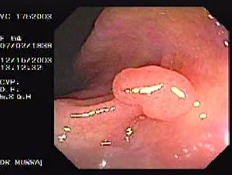 Pediculated Polyp of the descendent colon