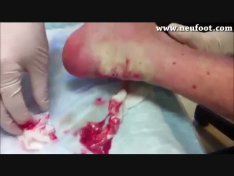 Gout Lesion Drainage