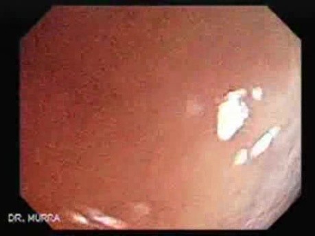 Huge Mass Of The Descending Colon (17 of 25)