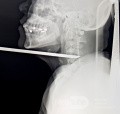 Spinal cord injury from spearfishing harpoon