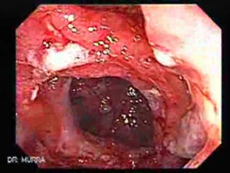 Multiple Adenomatous Polyps Of The Rectum (19 of 37)